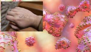 Primul caz de variolă la un copil